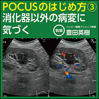 POCUSのはじめ方③〜消化器以外の病変に気づく