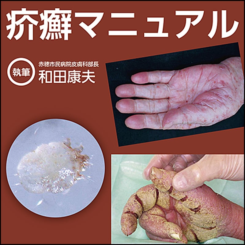 疥癬マニュアル | 日本医事新報社 Webコンテンツ販売サイト 免疥チェックポイント阻害薬 実践ガイドブック