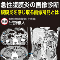 急性腹膜炎の画像診断〜腹膜炎を感じ取る画像所見とは