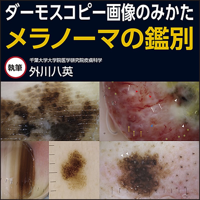 ダーモスコピー画像のみかた〜メラノーマの鑑別 | 日本医事新報社 Web