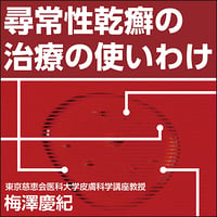 尋常性乾癬の治療の使いわけ
