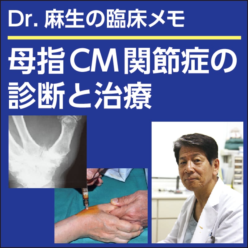 母指CM関節症の診断と治療〜Dr.麻生の臨床メモ | 日本医事新報社 Web