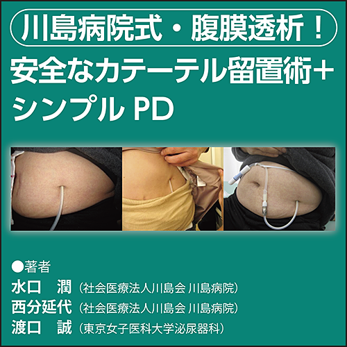 川島病院式・腹膜透析！ 安全なカテーテル留置術＋シンプルPD | 日本