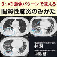 3つの画像パターンで覚える 間質性肺炎のみかた