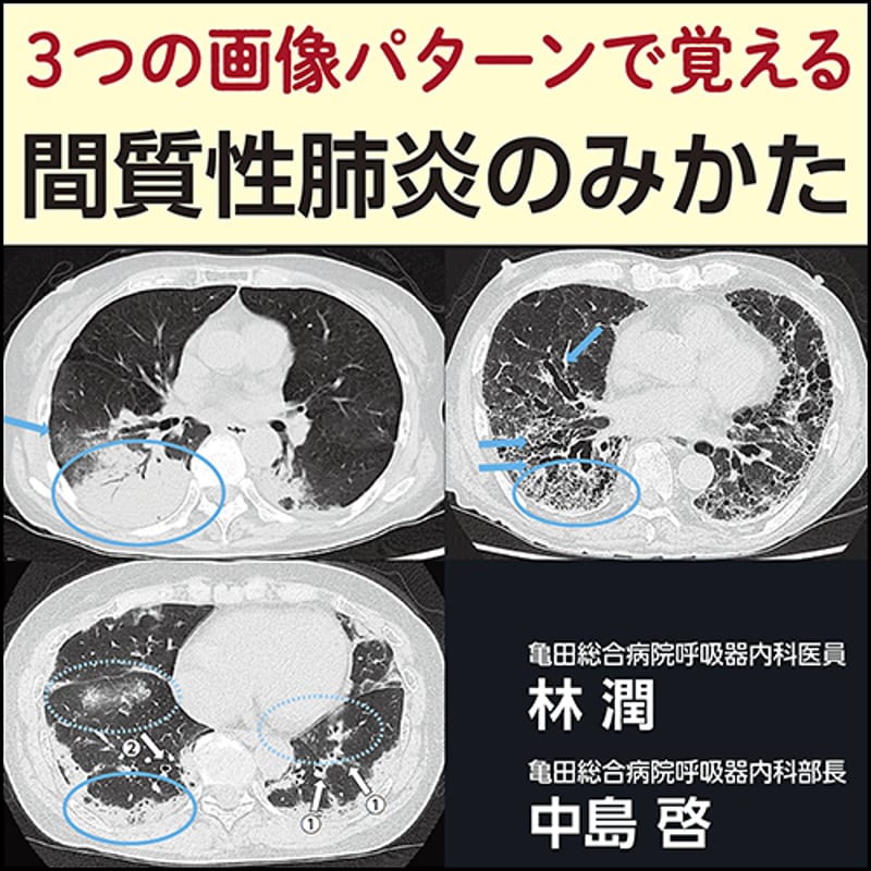 3つの画像パターンで覚える 間質性肺炎のみかた | 日本医事新