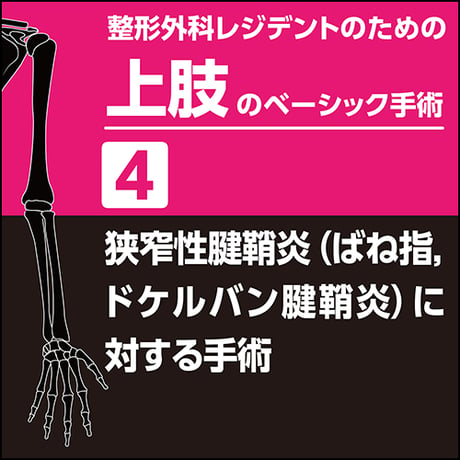 整形外科レジデントのための上肢のベーシック手術4　狭窄性腱鞘炎（ばね指，ドケルバン腱鞘炎）に対する手術（PDF版）