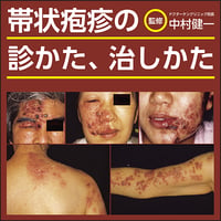 帯状疱疹の診かた、治しかた