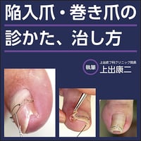 陥入爪・巻き爪の診かた、治しかた