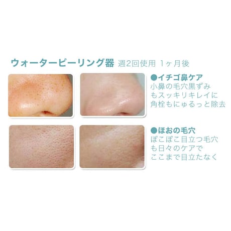 毛穴ケア美顔器 ウォーターピーリング器