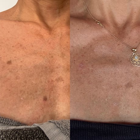重曹＆ひまし油だけで取れる肌シミ取り完全レクチャー動画