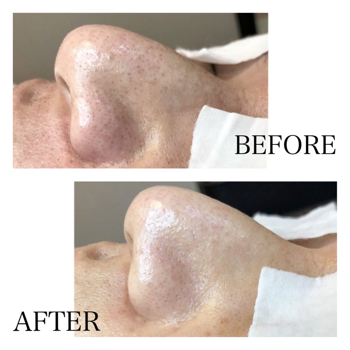 最新版　毛穴洗浄(ハイドラフェイシャル)FARSLIM 美顔器 タッチスクリーン 最新版毛穴洗浄(ハイドラフェイシャル)FARSLIM 美顔器 タッチスクリーン