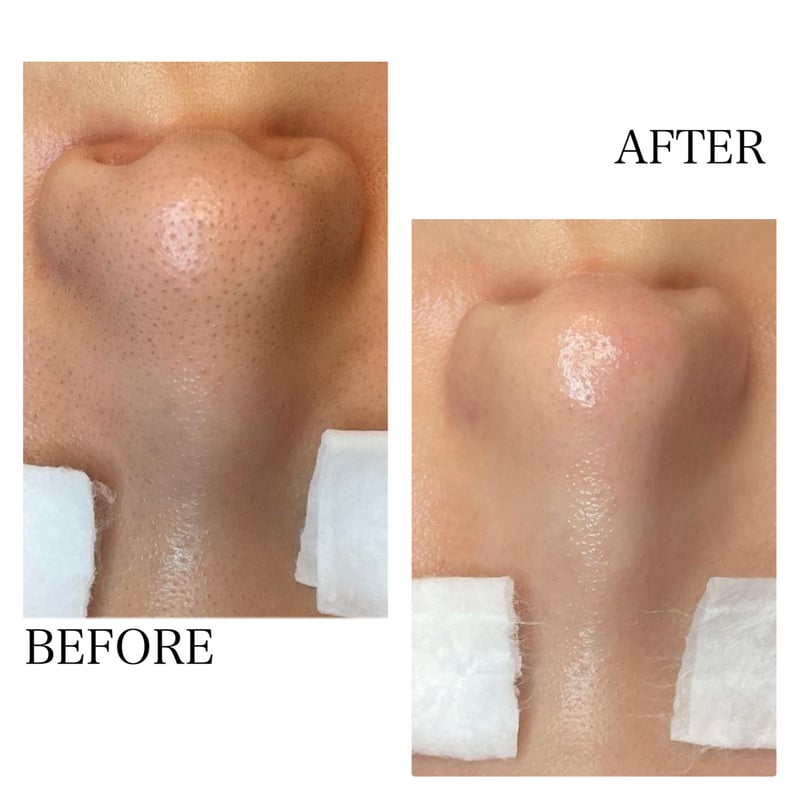 ハイドラフェイシャルマシン 毛穴黒ずみ汚れクリーニング溶液3本+  