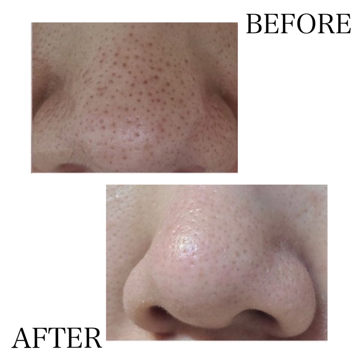 ハイドラフェイシャルマシン 毛穴黒ずみ汚れクリーニング溶液3本+  