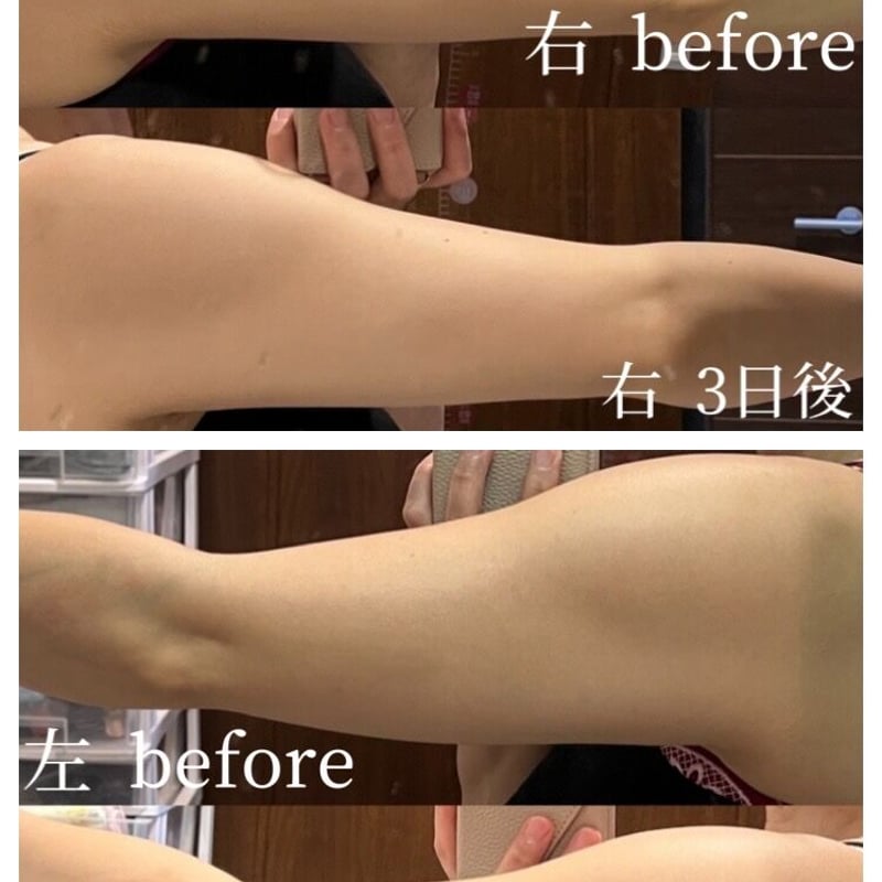 再入荷🌸たるみに‼️【ノンFシェイプ】二の腕・お腹・ヒップ