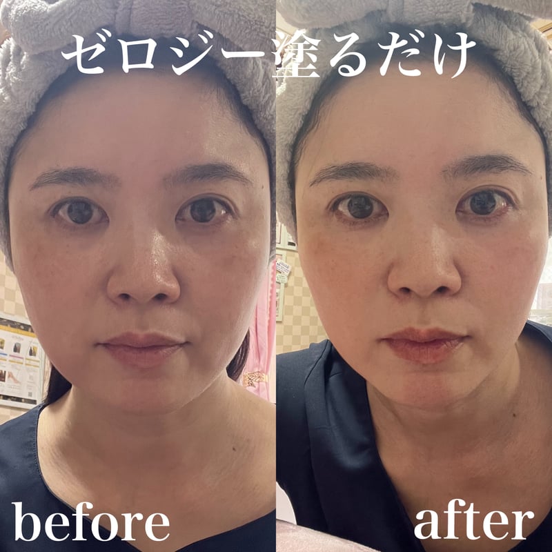 ゼロジーフリーフェイス　小顔 ゼロジーフリーフェイス 小顔