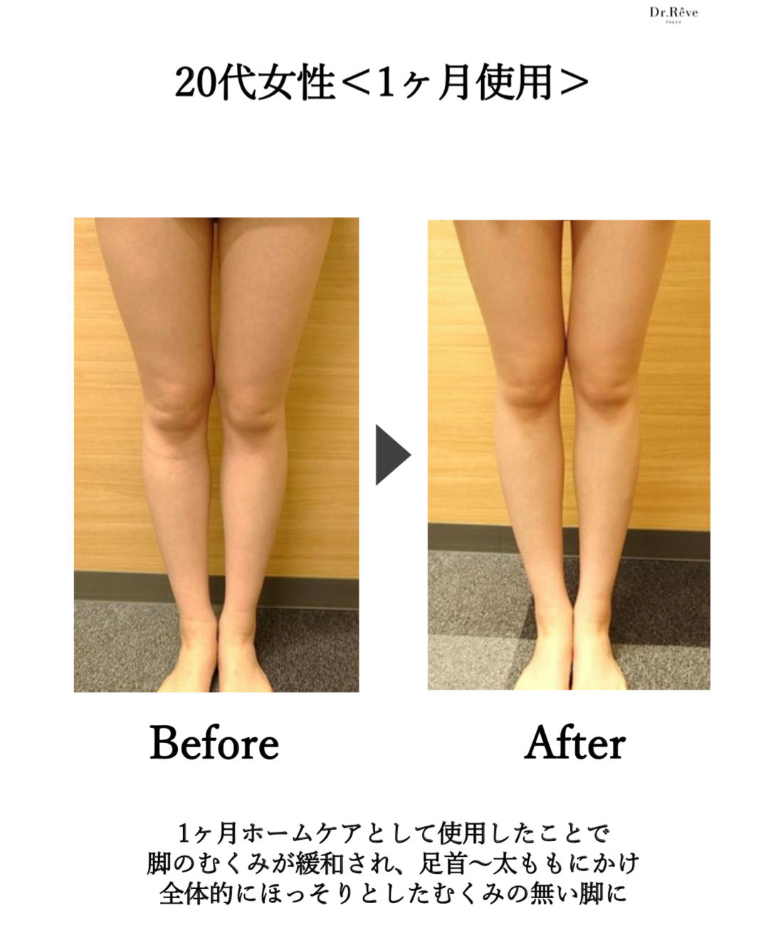 塗る脂肪溶解注射》メディアボディシェイプ〔スリミングクリーム