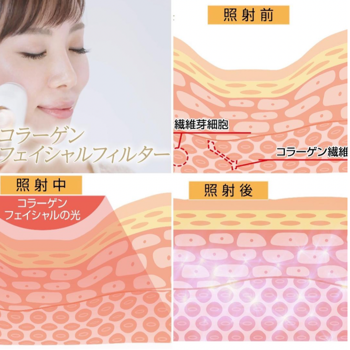 効果抜群の家庭用脱毛器 クリアエスピー ビート2 CLEAR/SP biiTo 効果抜群の家庭用脱毛器 クリアエスピー ビート2 CLEAR/SP biiTo