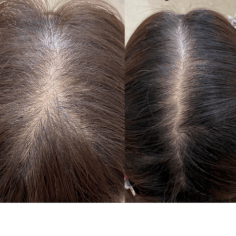 Procell Therapies：ヘア1回