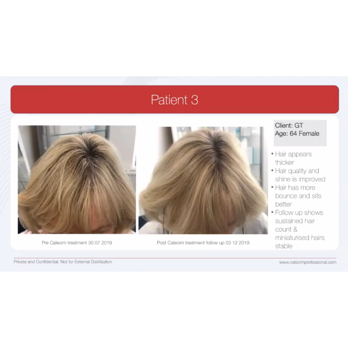 医療機関専売 CALECIM アドバンスド・ヘア・システム 5mL×6本 | TDC