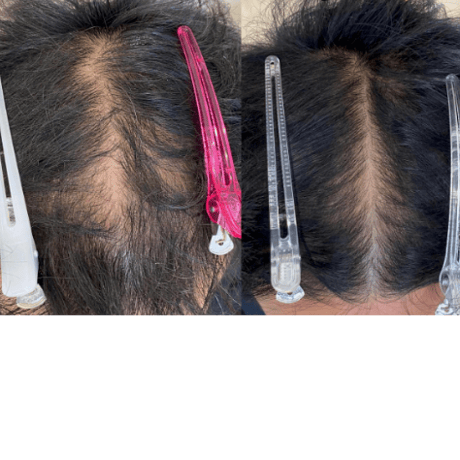 Procell Therapies：ヘア5回セット