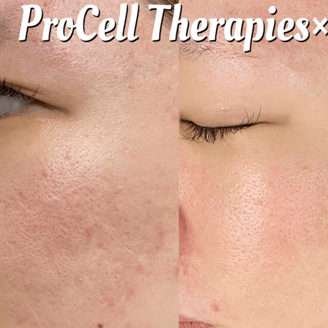 Procell Therapies：フェイシャル5回セット