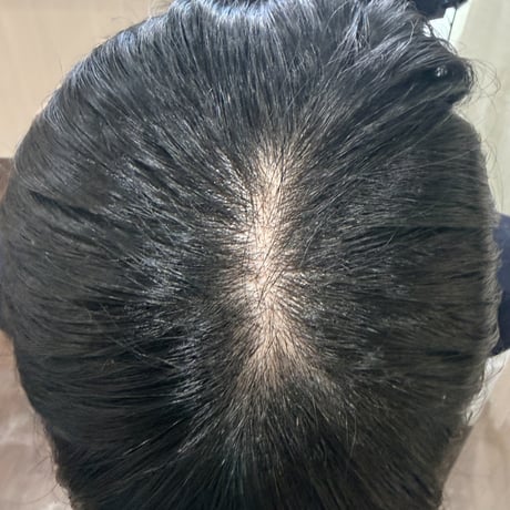 分け目用ヘアピース