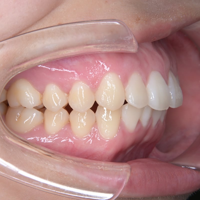 口腔内写真セット ミラーレス｜Nikon Z30リングストロボ仕様 | Dental