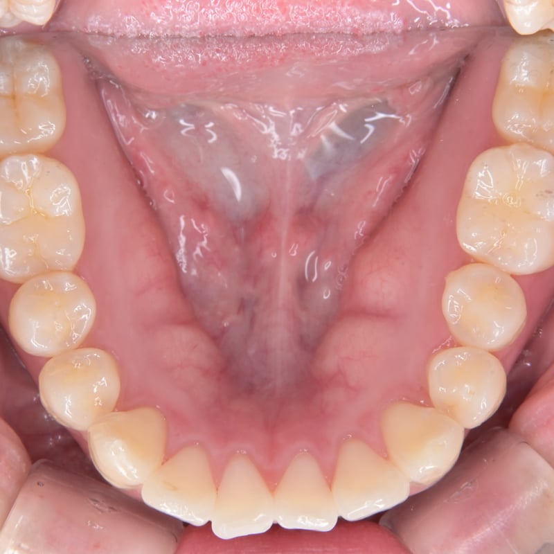 口腔内写真セット ミラーレス｜Nikon Z30リングストロボ仕様 | Dental