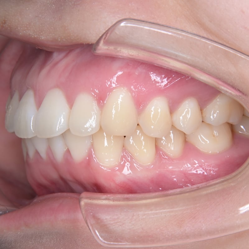 口腔内写真セット ミラーレス｜Nikon Z30リングストロボ仕様 | Dental