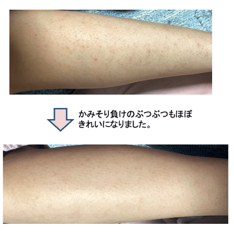 肌荒れにはエフェクトクリーム８７ｇ　持ち歩き用ミニサイズ付