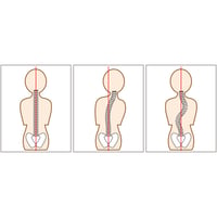 背骨側弯　Scoliosis