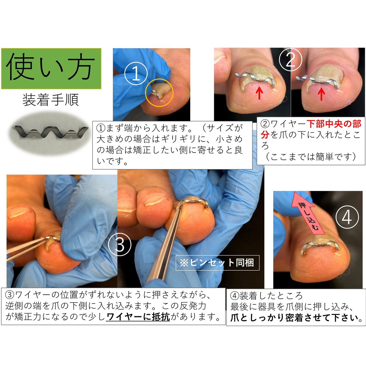 【 ネイル・エイド １６ｍｍ 】 巻き爪矯正・巻き爪治療・ブロック ...