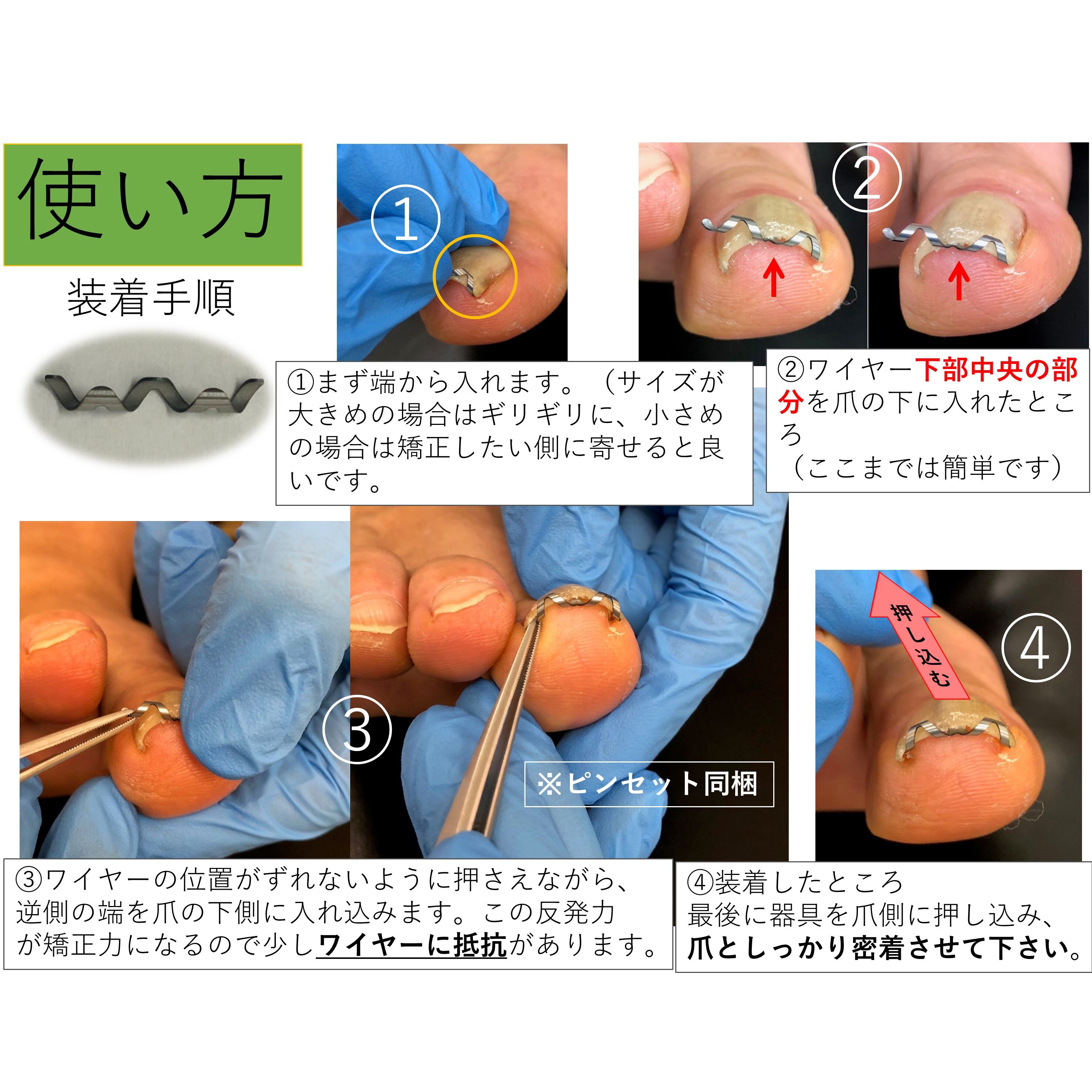新品　ネイル・エイド 巻き爪矯正 14mmと12mm 説明書ピンセット付き original