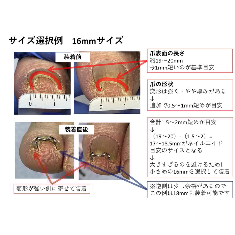 ネイルエイド　14mm　巻き爪矯正　２個セット 2個目購入の方限定※他モール初回購入可）ピンセットなし・説明書