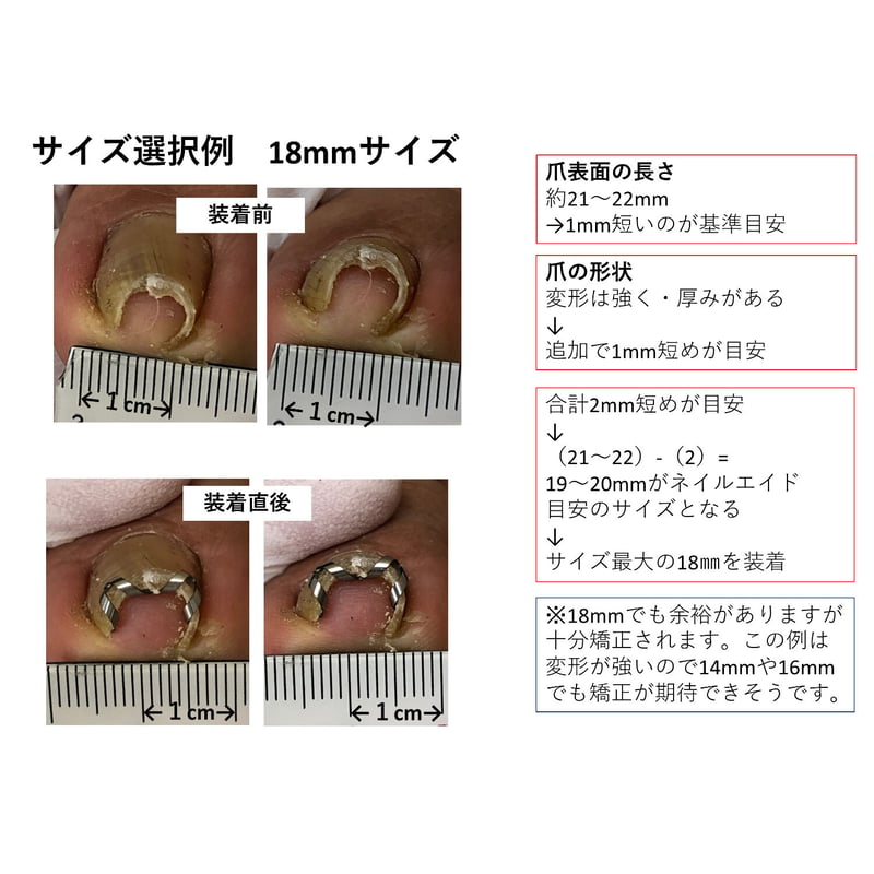 ネイル・エイド ミニ １０ｍｍ 】 巻き爪矯正・巻き爪治療・ブロック