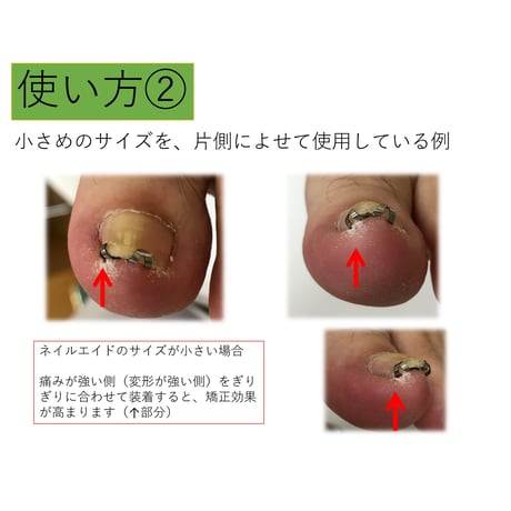 【　ネイル・エイド 　１６ｍｍ　】　巻き爪矯正・巻き爪治療・ブロック・ロボ・ガード・リフト・ワイヤー・クリップ