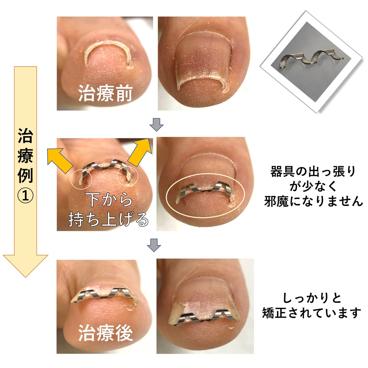 【 ネイル・エイド １８ｍｍ 】 巻き爪矯正・巻き爪治療・ブロック 