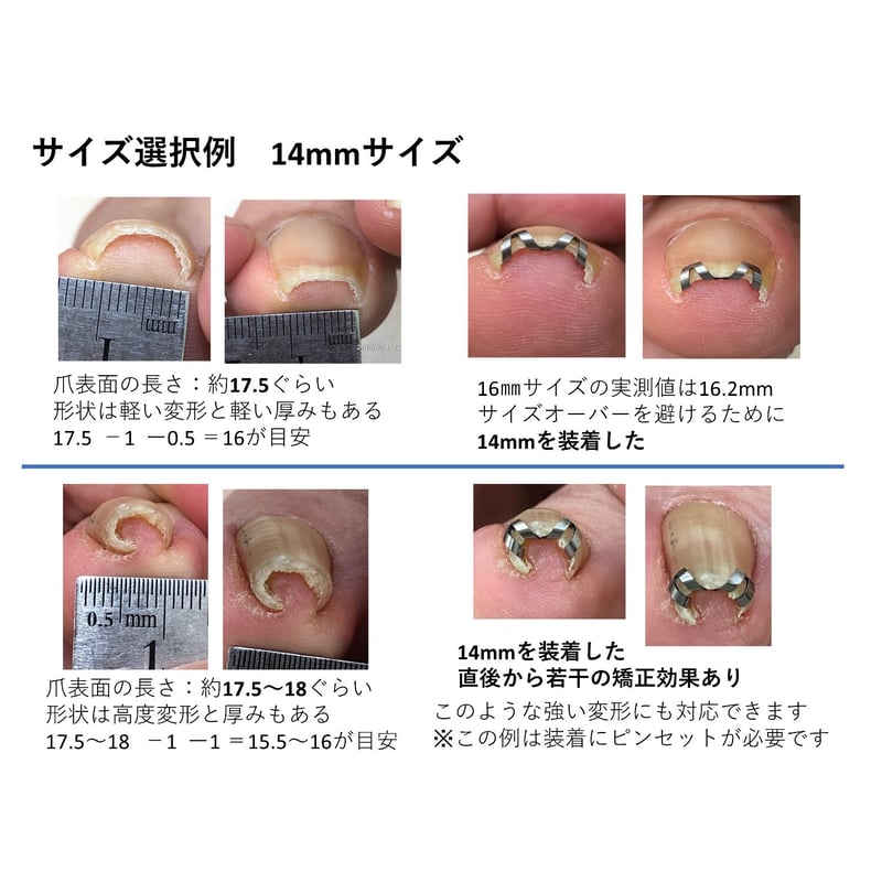ネイル・エイド ミニ 12mm 】 巻き爪矯正・巻き爪治療・ブロック