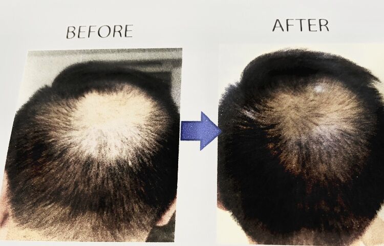 キャンペーン中！ ヒト幹細胞入り頭皮用育毛剤 3ヶ月分（2本セット 