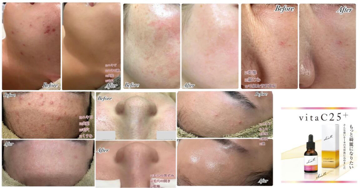 高濃度ピュアビタミンC25%美容液 shiall vitaC25+｜毛穴・くすみ