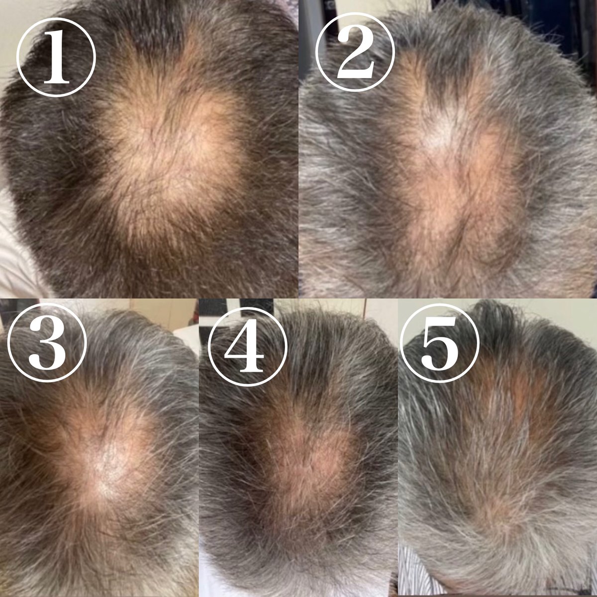 たるみ解消！】MAHHA エイジング美顔器（顔・頭皮・ボディ用電気針