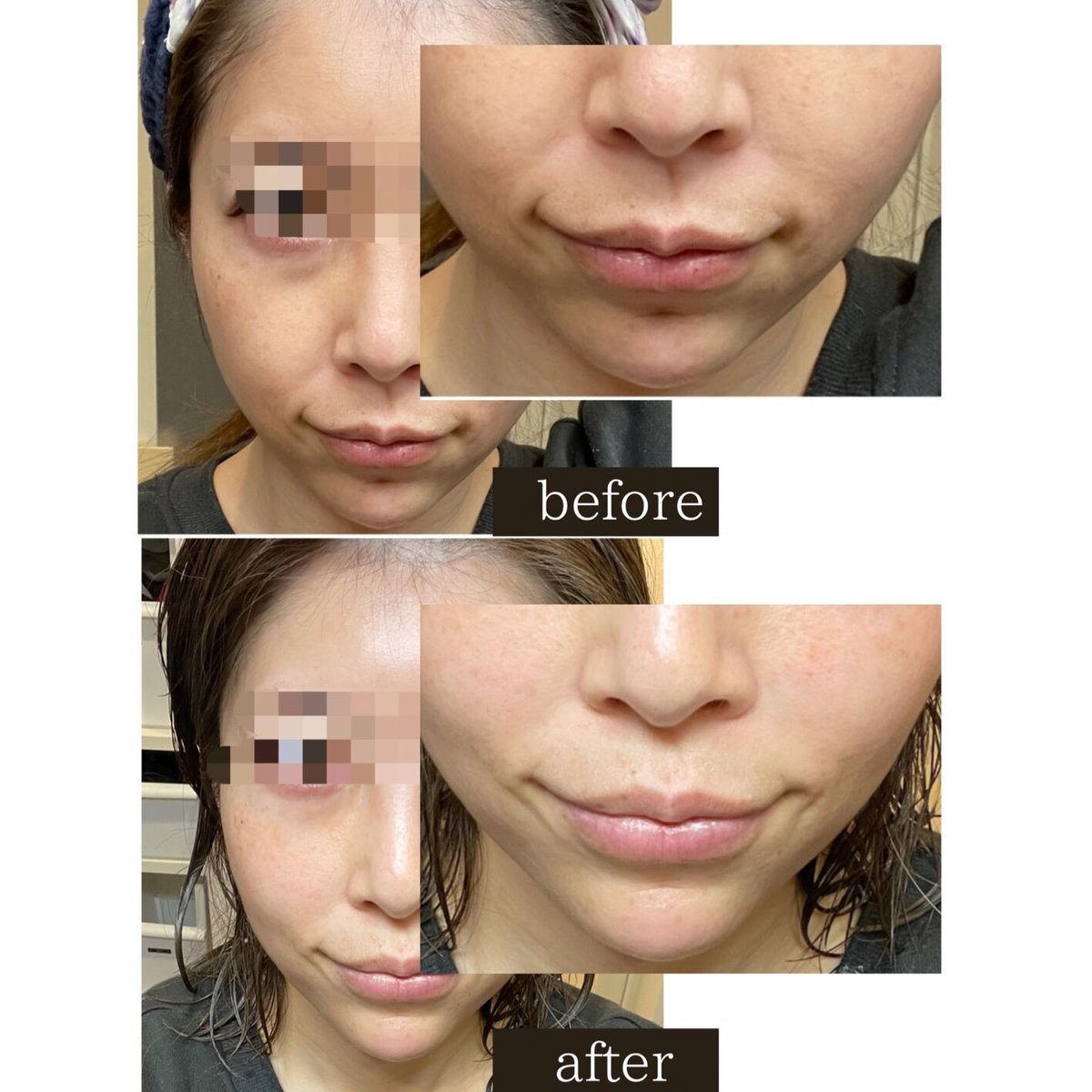 メディシュティーク炭酸ガスパック 1回分 | TT Beauty メディシュティーク炭酸ガスパック 1回分 | TT Beauty