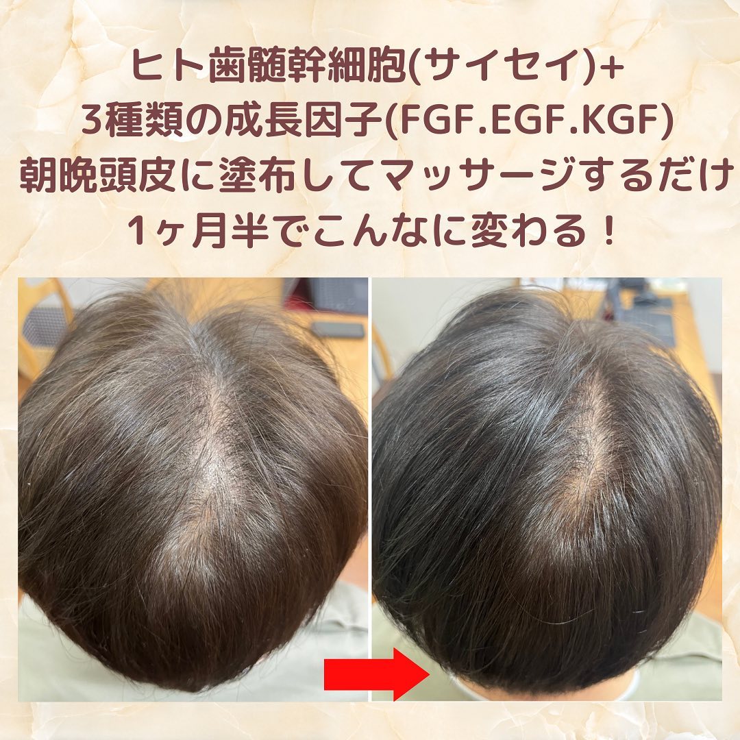 薄毛にお悩みの方へ！REVIセルスカルプ