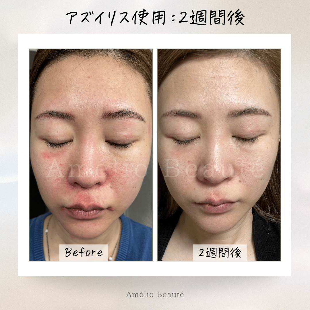 送料無料✨️アズイリス（As_iris）＋アズルクス《炭酸パック