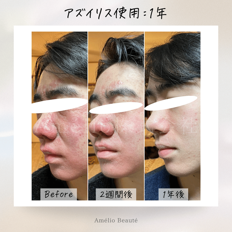 アズイリス＋アズシエル【炭酸ガスパック 肌質改善・保湿