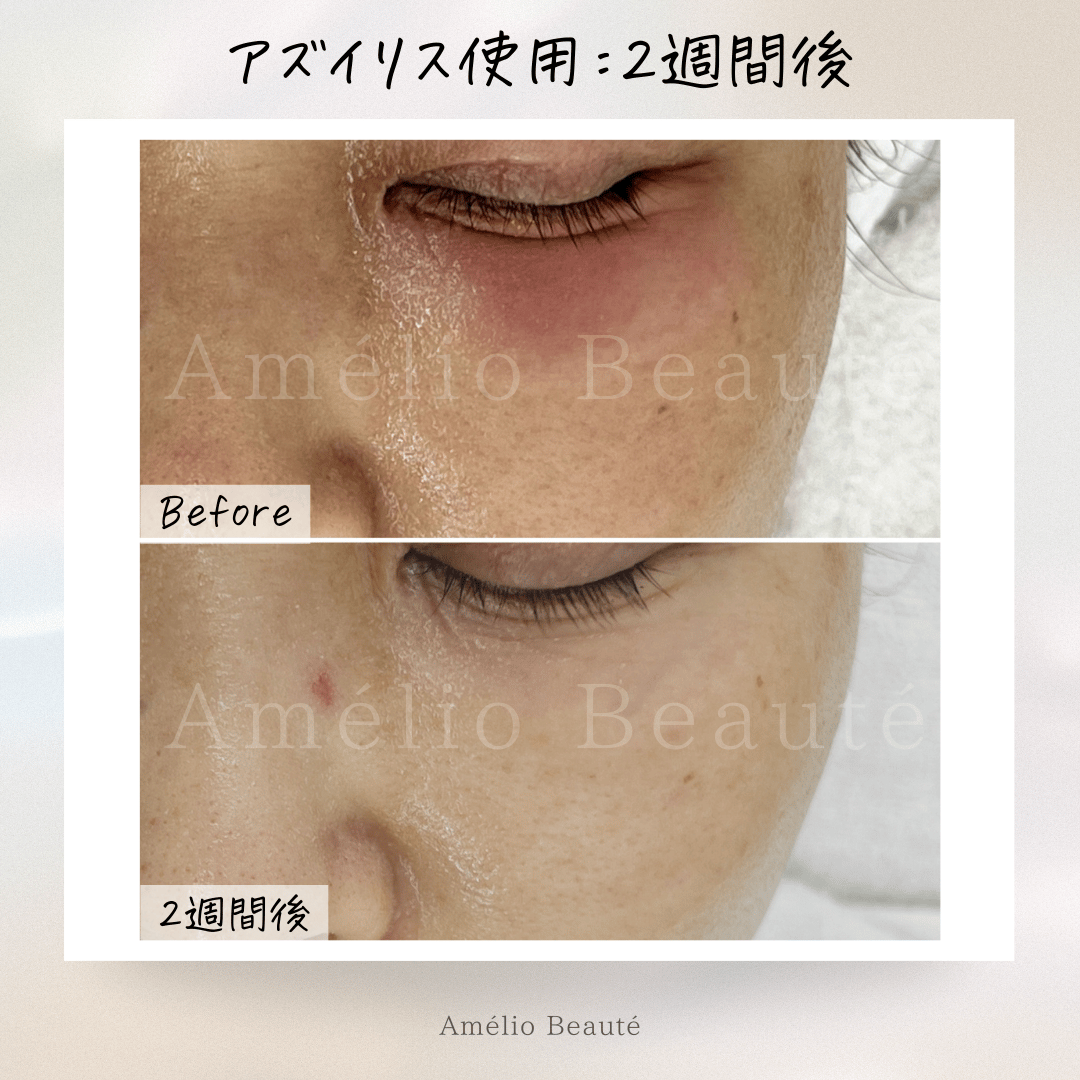 送料無料✨️アズイリス（As_iris）＋アズルクス《炭酸パック