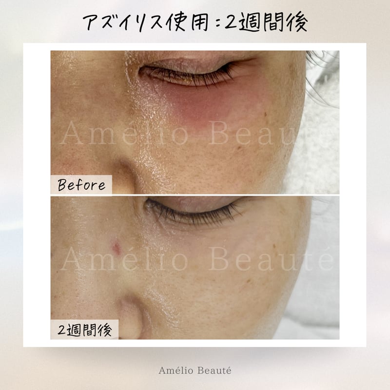 アズイリス+アズシエル【炭酸ガスパック 肌質改善・保湿 アズイリス+アズシエル【炭酸ガスパック 肌質改善・保湿