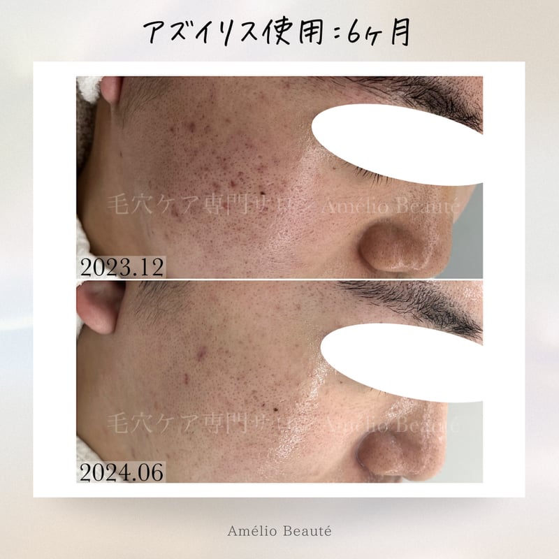 アズイリス+アズシエル【炭酸ガスパック 肌質改善・保湿 アズイリス+アズシエル【炭酸ガスパック 肌質改善・保湿