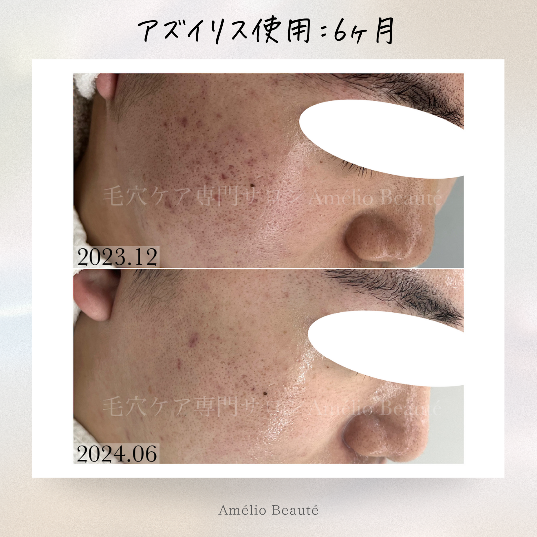 アズイリス+アズシエル【炭酸ガスパック 肌質改善・保湿 アズイリス+アズシエル【炭酸ガスパック 肌質改善・保湿