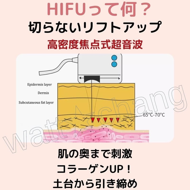 HIFU ハイフ 家庭用 美顔器 ジェル付 改善 対策 ウルセラ RF HIFU ハイフ 家庭用 美顔器 ジェル付 改善 対策 ウルセラ RF